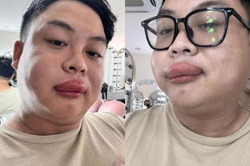 Bi hài cô dâu và thợ make up ở Vĩnh Long bị ong chích sưng vù mặt