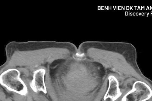 Cụ bà 77 tuổi nguy kịch vì thoát vị bịt