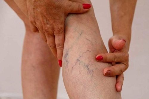 5 điều bác sĩ mạch máu nhắn nhủ bệnh nhân suy giãn tĩnh mạch ăn Tết vui khỏe, hạn chế gặp nhau trong bệnh viện