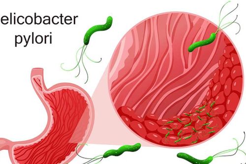 Viêm loét dạ dày - Cảnh giác nguy cơ tái phát dịp cuối năm
