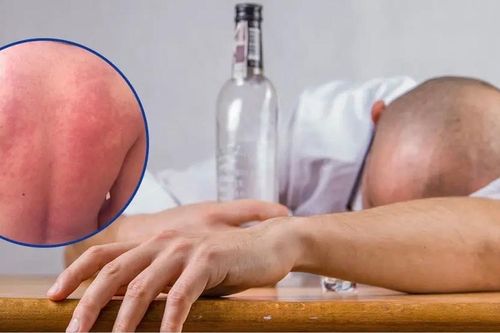 Không chủ quan khi uống rượu bia ngày tết với tình trạng 'mẩn ngứa, nóng bừng'