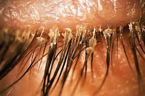 Người phụ nữ 24 tuổi khó chịu ở mí mắt, bác sĩ sốc khi gắp ra thứ 'đáng sợ' chi chít trên mi