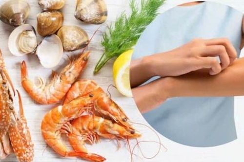 Bộ Y tế khuyến cáo sau một số vụ nghi ngộ độc, nhập viện liên quan đến hải sản