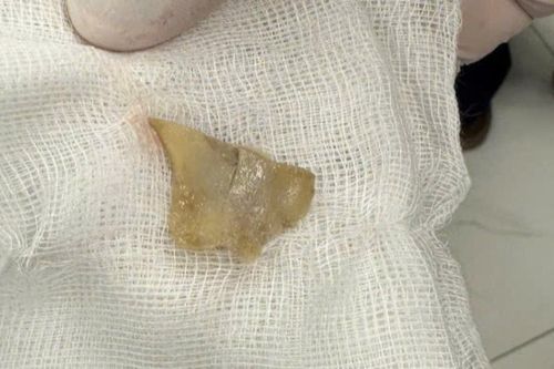 Ăn miến ngày Tết, bé gái bị mảnh xương mắc ở thực quản