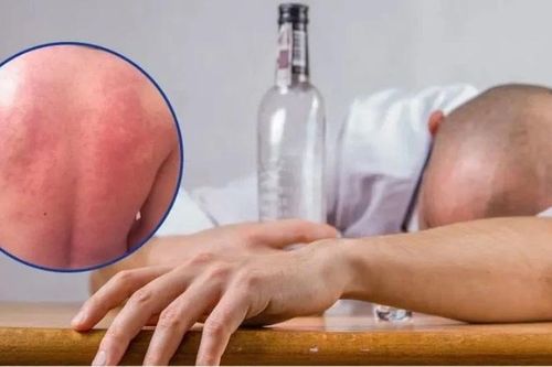 Những điều lưu ý để 'giải rượu' đúng cách