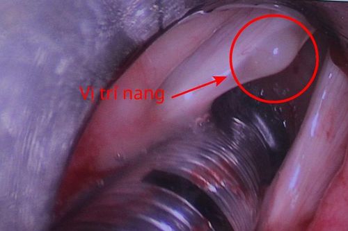 Người phụ nữ tìm lại giọng nói sau 5 năm khàn tiếng do nang dây thanh