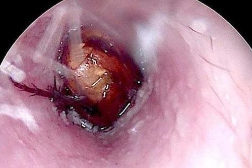 Nhờ tiệm cắt tóc lấy dị vật, bệnh nhân bị xung huyết ống tai