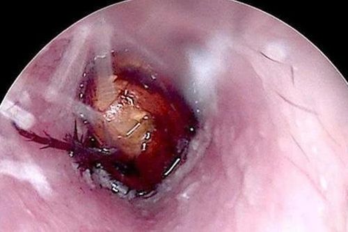 Cháu bé đau tai dữ dội, bác sĩ sốc ngang phát hiện bí mật 'đáng sợ' bên trong