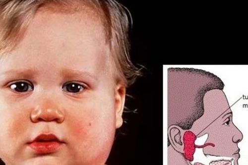 Bệnh quai bị bao lâu thì khỏi?
