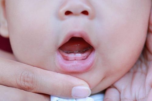 Dấu hiệu trẻ bắt đầu mọc răng đầu tiên