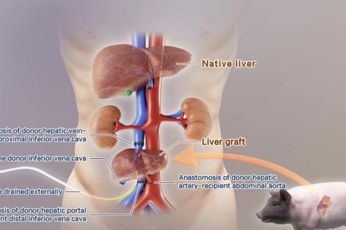 Phương pháp điều trị suy gan truyền ngoài cơ thể với gan lợn chỉnh sửa gene