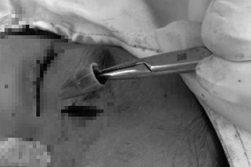 Bé trai đau vùng mắt dữ dội, bác sĩ sốc khi phát hiện dị vật 'tàng hình'