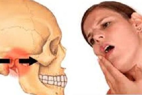 Trật khớp thái dương hàm có biểu hiện gì?