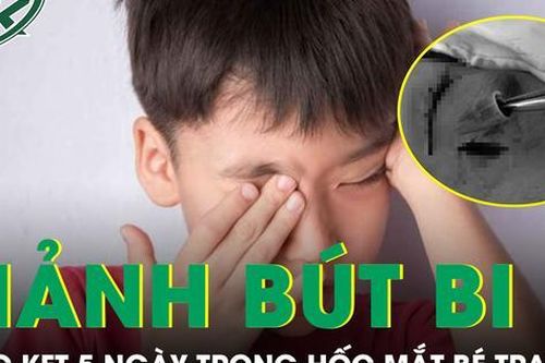 Gắp đoạn bút bi nhựa mắc kẹt 5 ngày trong hốc mắt bé trai