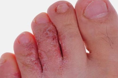 Nhiễm nấm, viêm da mùa mưa cần cảnh giác khi độ ẩm tăng cao