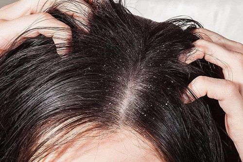 Viêm da tiết bã da đầu gây gàu nhiều, dễ tái phát kéo dài