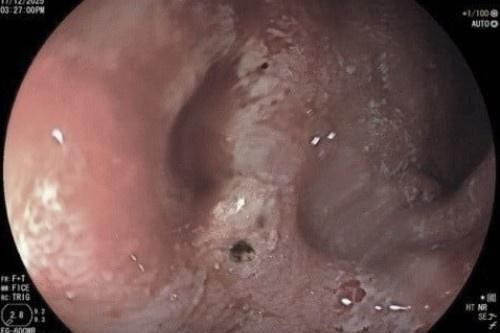 Một thói quen 'tự hủy' dạ dày rất nhiều người trẻ mắc