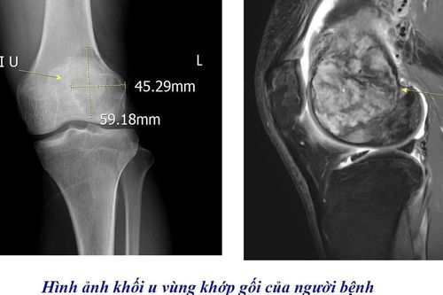 Đau khớp gối không đi lại được, tưởng bệnh xương khớp không ngờ u khổng lồ