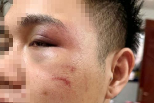 Hà Nội: Từ chối chở khách say xỉn, tài xế xe công nghệ bị đánh sưng mặt