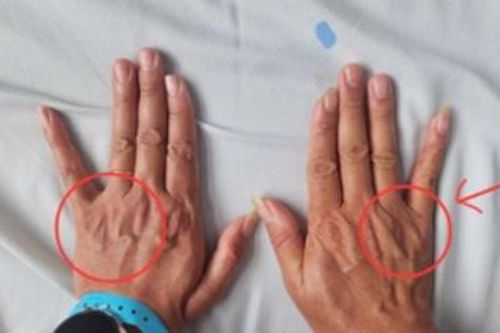 Tê ngón tay út tưởng chuyện nhỏ, người đàn ông suýt teo cả bàn tay