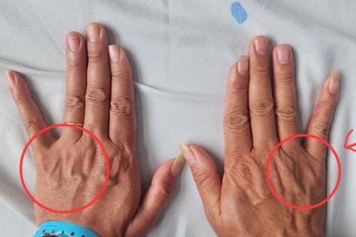 Tê ngón út kéo dài, người đàn ông suýt teo cơ bàn tay