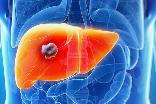 Người đàn ông 44 tuổi phát hiện ung thư gan sau khi xét nghiệm men gan tăng cao: Có 1 thói quen nhiều người Việt mắc phải