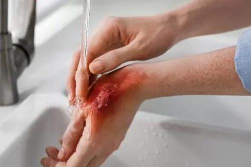 Sơ cứu bỏng đúng cách hạn chế biến chứng và sẹo