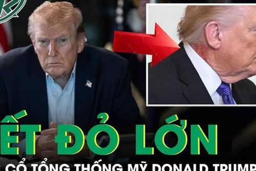 Tổng thống Mỹ Donald Trump xuất hiện với vết đỏ lớn trên cổ gây đồn đoán về sức khỏe