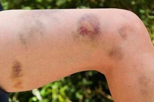 Người phụ nữ nguy kịch sau 2 tháng dùng thuốc nam không rõ nguồn gốc