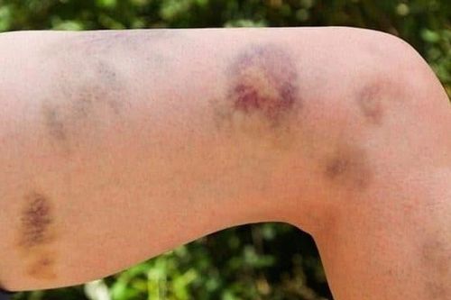 Dùng thuốc nam không rõ nguồn gốc, người phụ nữ mắc bệnh hiếm
