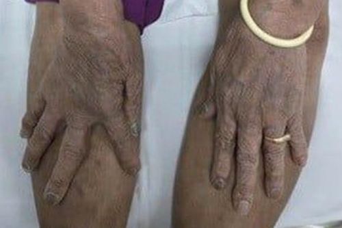 Tin vào thuốc lạ 'uống thấy khỏe', cụ ông 87 tuổi nhập viện trong tình trạng nguy kịch