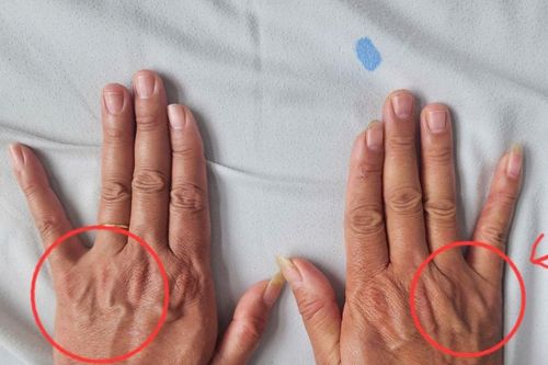 Người đàn ông suýt teo cả bàn tay vì tê ngón tay út