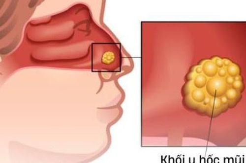 Nghẹt mũi kéo dài cảnh giác với ung thư hốc mũi