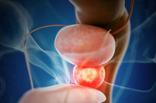 Người đàn ông 68 tuổi phát hiện ung thư tuyến tiền liệt từ dấu hiệu nhiều nam giới Việt bỏ qua