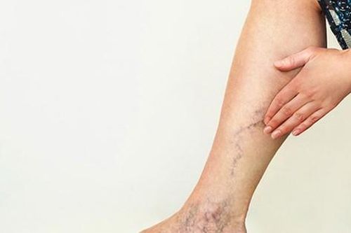 Yếu tố nguy cơ không nên xem nhẹ của suy tĩnh mạch chi dưới