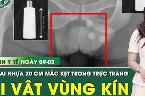 Bản tin Y tế 9/3: Lấy chai nhựa dài khoảng 20cm mắc kẹt sâu trong trực tràng người đàn ông