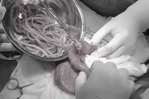 Thiếu niên 15 tuổi bị loét ruột nặng, bên trong chứa đầy giun đũa