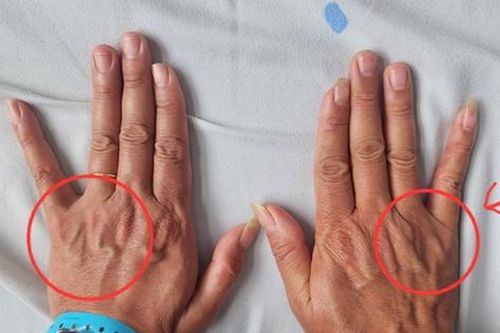 Tê ngón tay út tưởng chuyện nhỏ, người đàn ông 51 tuổi suýt bị teo cả bàn tay