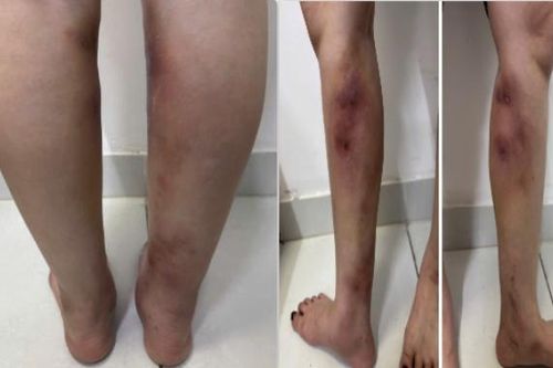 Chân biến dạng sau tiêm filler tại nhà
