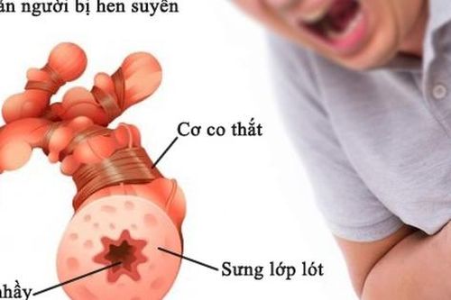 Nhận biết sớm cơn hen phế quản nguy kịch