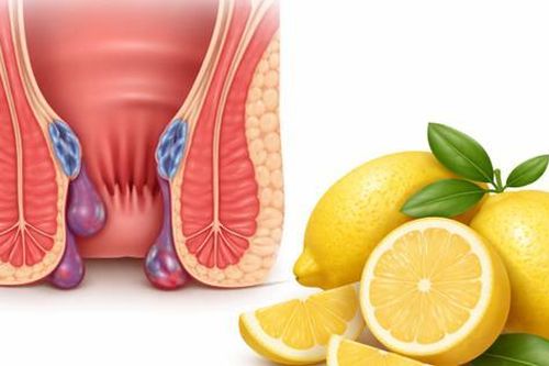 3 cách dùng chanh giảm triệu chứng bệnh trĩ