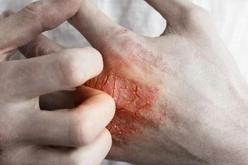 Bí quyết kiểm soát và phòng ngừa eczema hiệu quả
