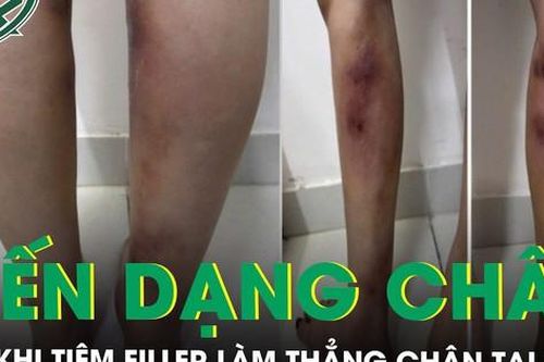 Cô gái 29 tuổi biến dạng hai cẳng chân sau khi tiêm filler làm thẳng chân tại nhà