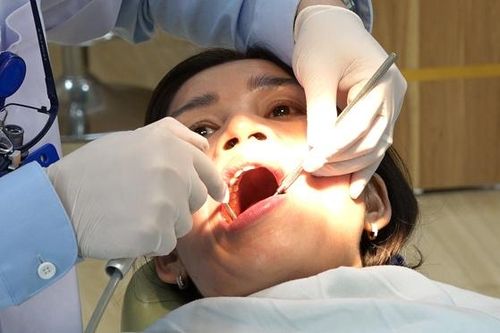 Nên lấy cao răng bao lâu một lần?