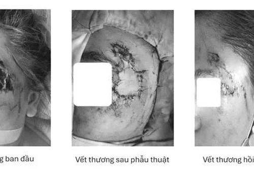Ghép da thành công cho người bệnh bị hoại tử vùng mặt sau tai nạn giao thông