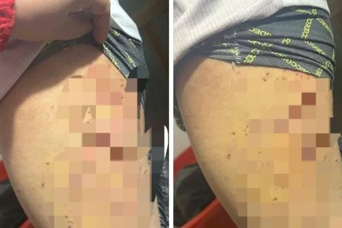 Nữ sinh lớp 7 bị bạn dùng bút bi đâm chi chít vào đùi