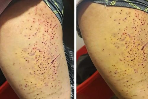 Tranh chấp chỗ ngồi, nữ sinh lớp 7 dùng bút bi đâm nhiều lần vào đùi bạn học