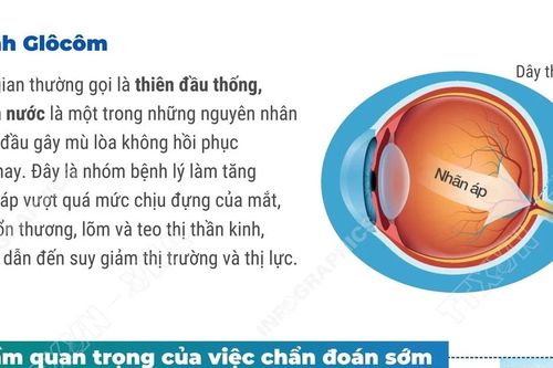 Chủ động khám mắt định kỳ để chẩn đoán sớm bệnh bệnh Glôcôm