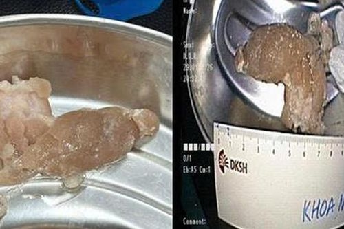 Nuốt vội miếng thịt trong bữa tối, người đàn ông suýt tắc thở