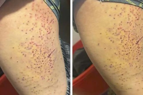 Đã rõ nguyên nhân học sinh lớp 7 ở Lào Cai bị bạn cùng lớp dùng bút đâm vào đùi